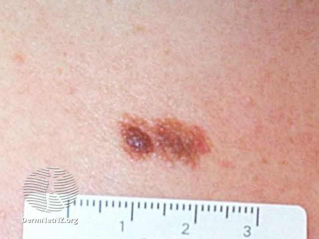 File:Atypical naevus (DermNet NZ lesions-atypical-naevi-600).jpg