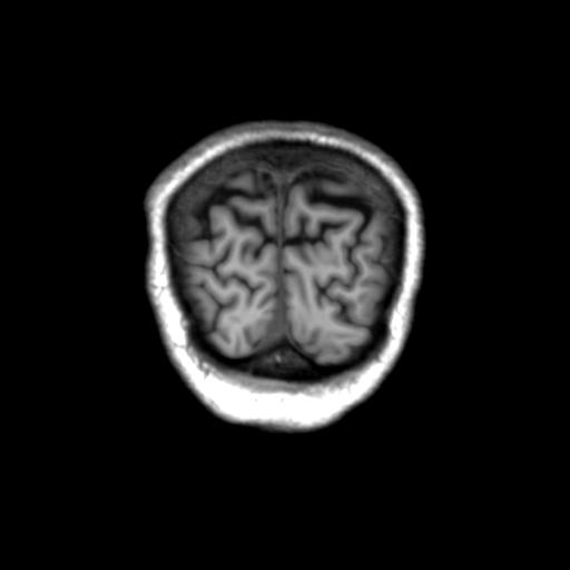 Autoimmune limbic encephalitis (Radiopaedia 30363-31005 Coronal T1 7).jpg