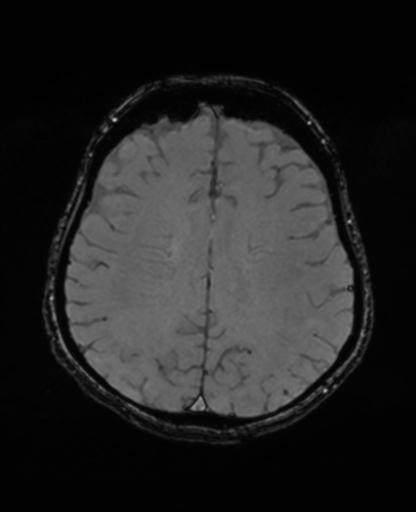 Autoimmune limbic encephalitis (Radiopaedia 30363-31005 SWI - magnitude 53).jpg