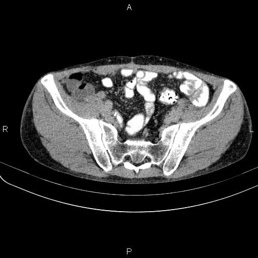 Autoimmune pancreatitis (Radiopaedia 84925-100431 Axial C+ delayed 72).jpg