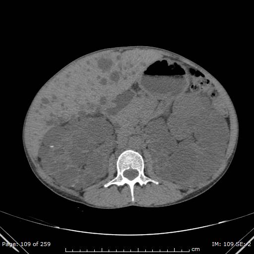 File:Autosomal dominant polycystic kidney disease (Radiopaedia 44122-47684 Axial 17).jpg