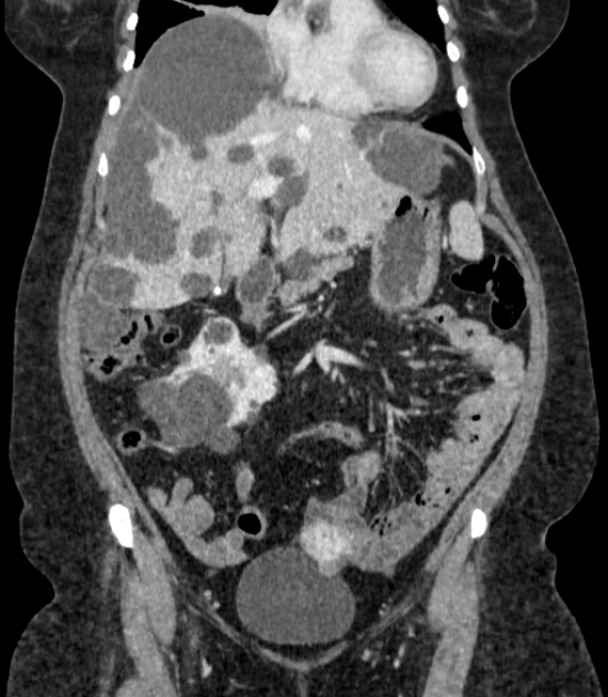 Autosomal dominant polycystic kidney disease (Radiopaedia 57124-64017 B 28).jpg