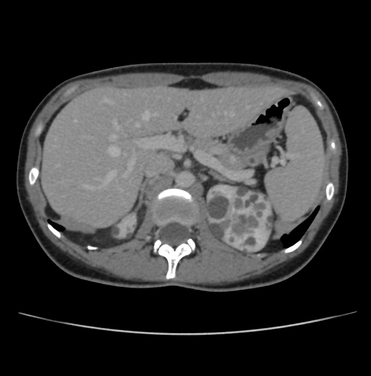 Autosomal dominant polycystic kidney disease - early onset (Radiopaedia 40734-43387 A 14).jpg