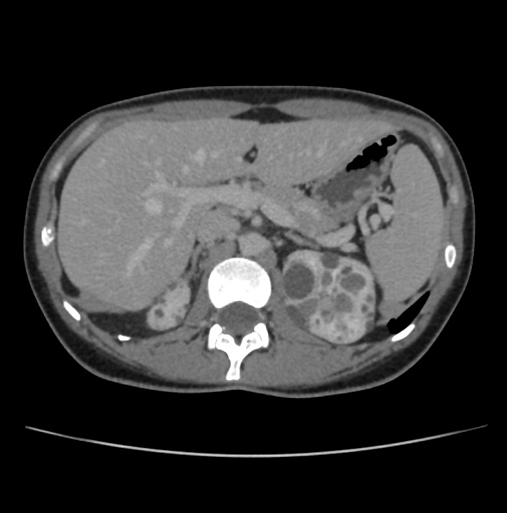 Autosomal dominant polycystic kidney disease - early onset (Radiopaedia 40734-43387 A 15).jpg
