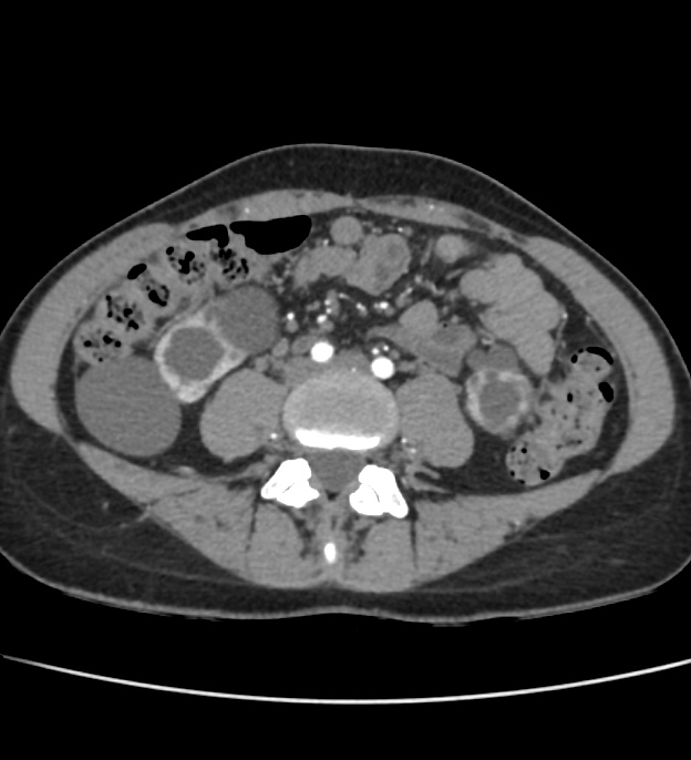 Autosomal dominant polycystic kidney disease - early onset (Radiopaedia 40734-43387 B 49).jpg