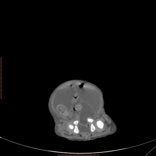 File:Autosomal recessive polycystic kidney disease associated with Caroli disease (Radiopaedia 61932-69984 Axial non-contrast 336).jpg