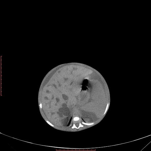 Autosomal recessive polycystic kidney disease associated with Caroli disease (Radiopaedia 61932-69984 B 135).jpg