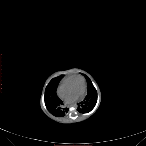 Autosomal recessive polycystic kidney disease associated with Caroli disease (Radiopaedia 61932-69984 B 84).jpg
