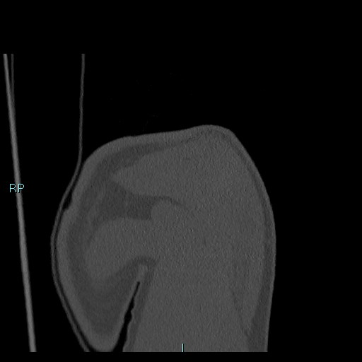 Avascular necrosis after fracture dislocations of the proximal humerus (Radiopaedia 88078-104655 Coronal bone window 37).jpg