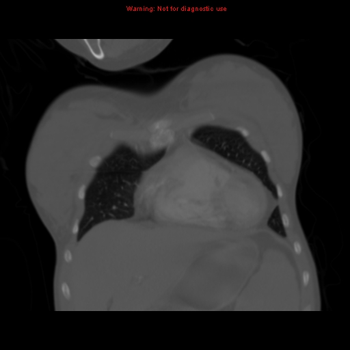 File:Avascular necrosis in sickle cell disease (Radiopaedia 17448-17152 Coronal bone window 26).jpg