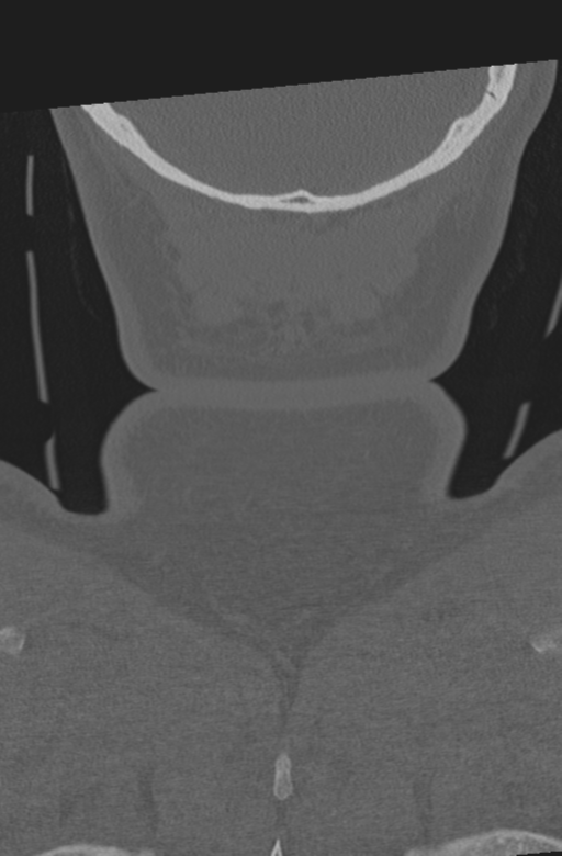 Axis peg fracture (type 3) and atlas lateral mass (type 4) fracture (Radiopaedia 37474-39324 Coronal bone window 68).png