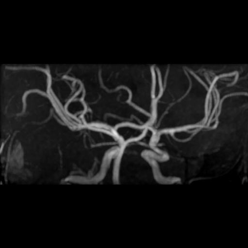 File:Azygos anterior cerebral artery (Radiopaedia 17059-16756 MRA 3).jpg