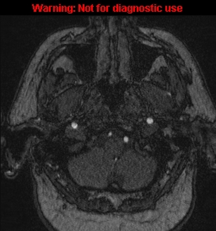 Azygos anterior cerebral artery (Radiopaedia 59325-66677 Axial MRA 8).jpg