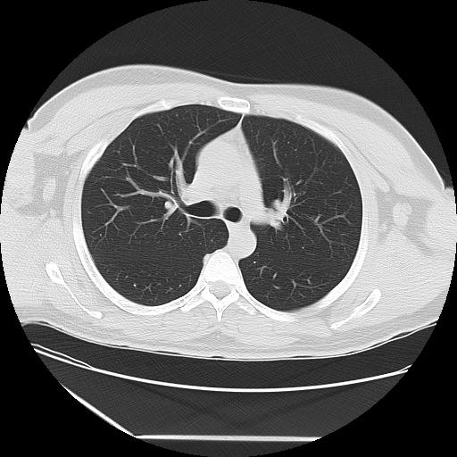 Azygos fissure (Radiopaedia 88181-104784 Axial lung window 18).jpg