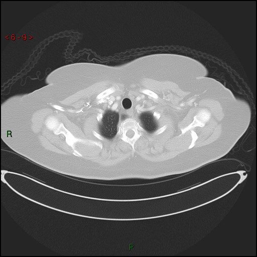 Azygos fissure and lobe (Radiopaedia 47620-52278 Axial lung window 9).jpg