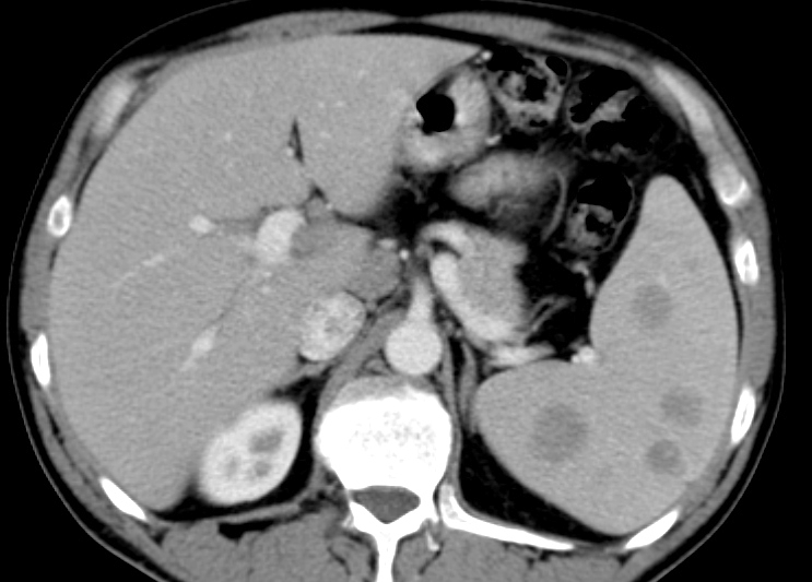File:B-cell lymphoma of the spleen (Radiopaedia 15877).jpg