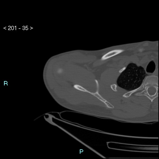 File:Bankart lesion with glenoid bone defect - assessment TC with PICO method (Radiopaedia 42855-93901 Axial bone window 34).jpg