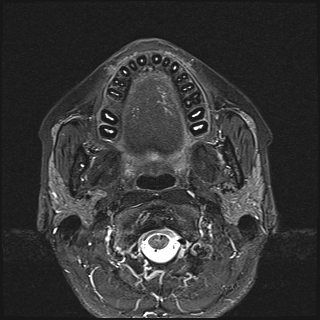 File:Basal cell carcinoma - nasal region (Radiopaedia 70292-80365 Axial STIR 20).jpg