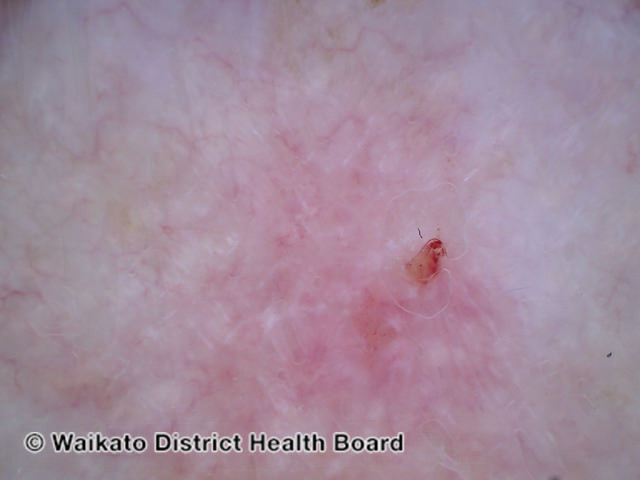 File:Basal cell carcinoma affecting the arms and legs 8 dermoscopy (DermNet NZ bcc-8-derm).jpg
