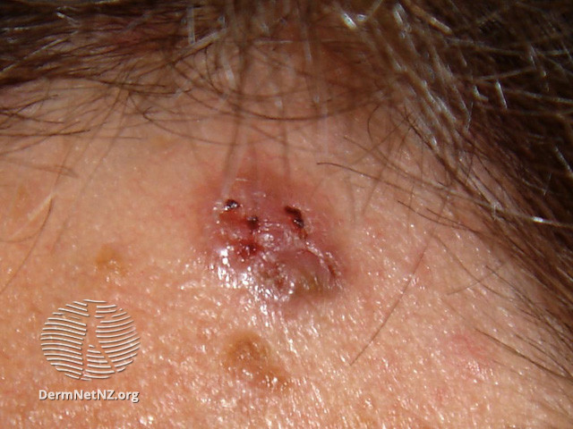 File:Basal cell carcinoma affecting the face (DermNet NZ lesions-bcc-face-0797).jpg