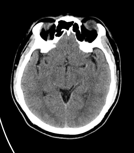 File:Basal ganglia hemorrhage - hypertensive (Radiopaedia 42227-45304 Axial non-contrast 14).png