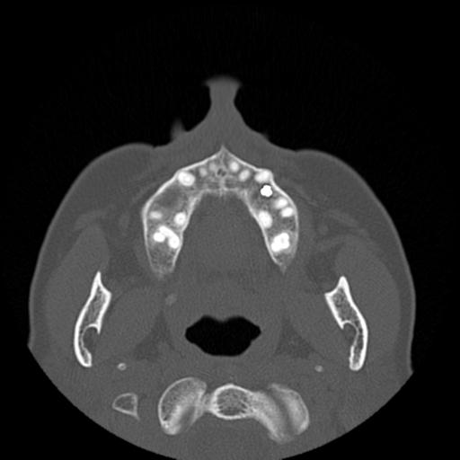 File:Base of skull chondrosarcoma (Radiopaedia 30410-31071 Axial bone window 3).jpg