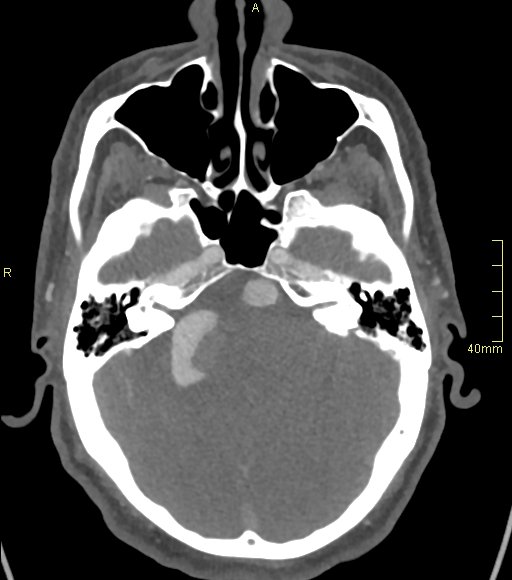 Basilar artery aneurysm (Radiopaedia 56261-62932 A 57).jpg