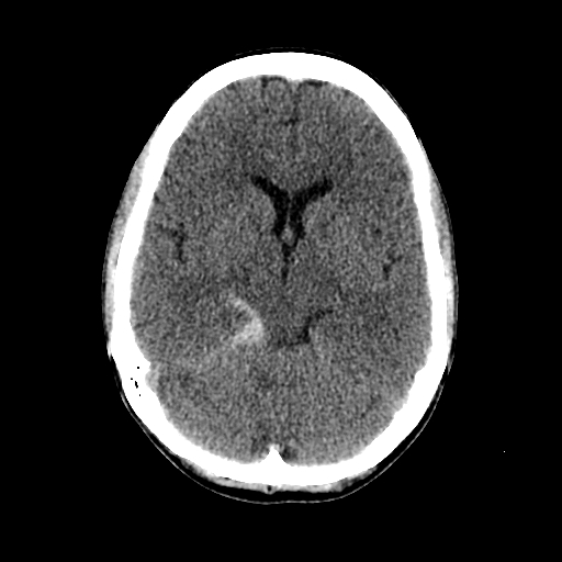 File:Basilar artery perforator aneurysm (Radiopaedia 82455-96597 Axial non-contrast 17).jpg