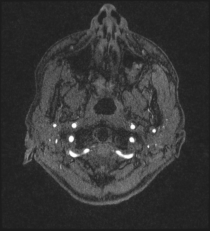 Basilar artery perforator aneurysm (Radiopaedia 82455-97733 Axial MRA 3).jpg