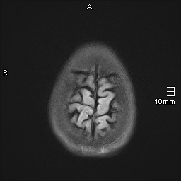 File:Basilar artery perforator aneurysm (Radiopaedia 82455-99523 Axial FLAIR 21).jpg