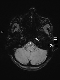 Basilar artery perforator aneurysm (Radiopaedia 82455-99523 Axial SWI 11).jpg