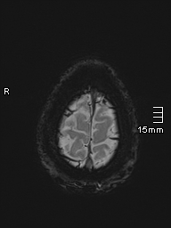 Basilar artery perforator aneurysm (Radiopaedia 82455-99523 Axial SWI 63).jpg