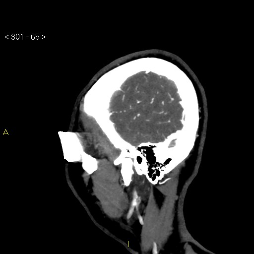 Basilar artery thrombosis (Radiopaedia 16260-15944 C 59).jpg