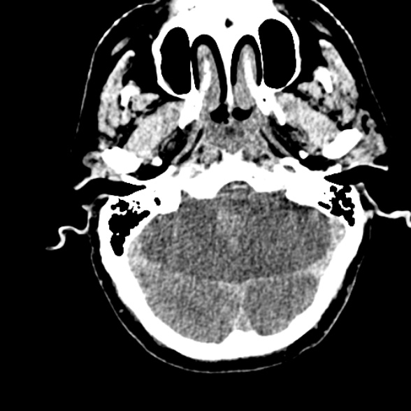 Basilar artery thrombosis (Radiopaedia 53351-59352 Axial non-contrast 32).jpg