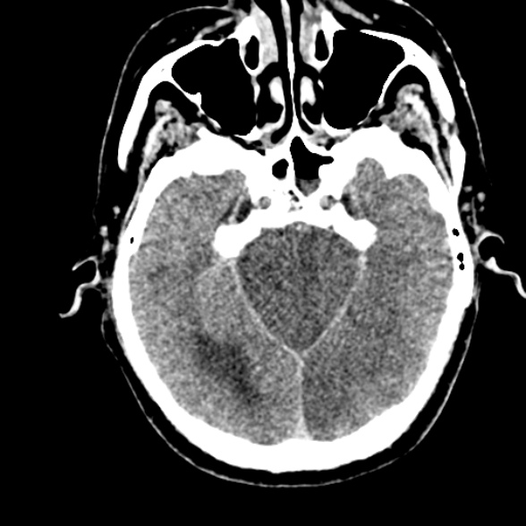 Basilar artery thrombosis (Radiopaedia 53351-59352 Axial non-contrast 43).jpg