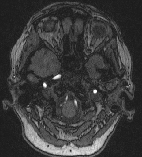 Basilar tip aneurysm (Radiopaedia 26504-26632 MRA 28).jpg