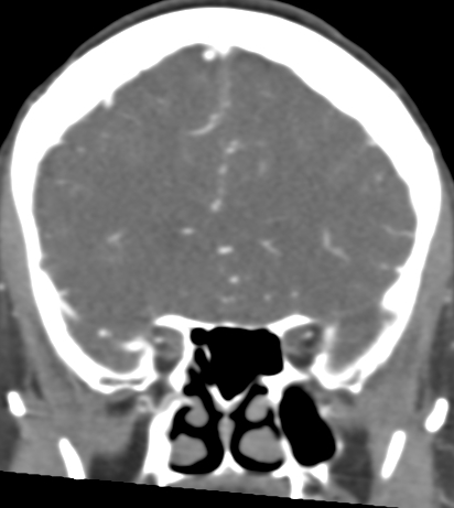 Basilar tip aneurysm with coiling (Radiopaedia 53912-60086 B 44).jpg