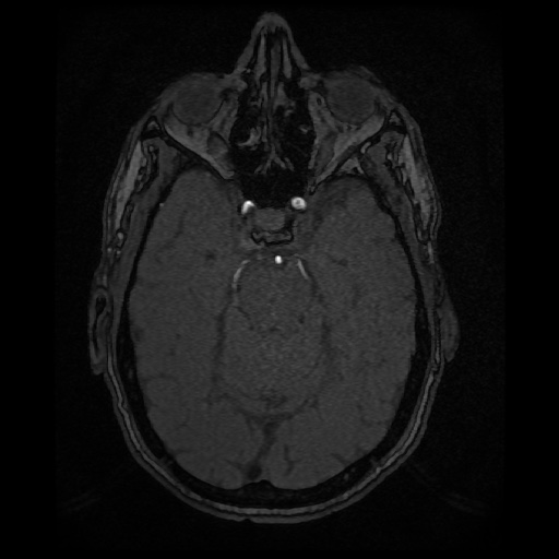 Basilar top and left middle cerebral artery aneurysm (Radiopaedia 61965-70031 Axial MRA 52).jpg