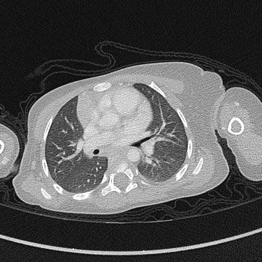 Beckwith-Wiedeman syndrome with bilateral Wilms tumors (Radiopaedia 60850-68629 Axial lung window 31).jpg