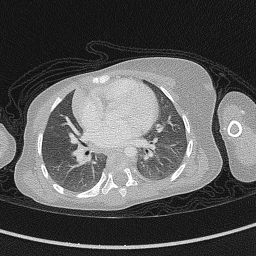 Beckwith-Wiedeman syndrome with bilateral Wilms tumors (Radiopaedia 60850-68629 Axial lung window 36).jpg