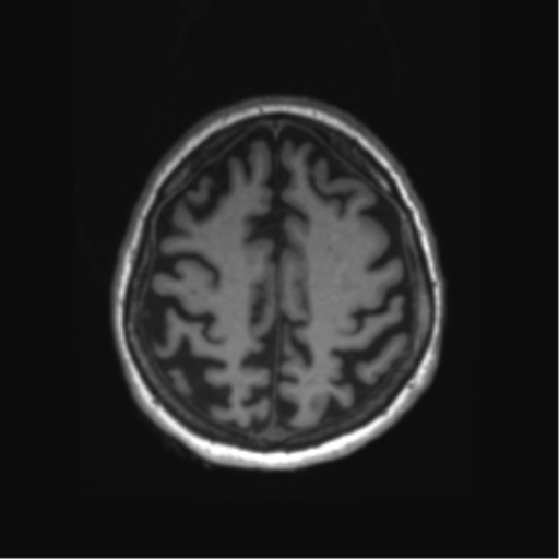 File:Behavioral variant frontotemporal dementia and late onset schizophrenia (Radiopaedia 52197-58083 Axial T1 16).png