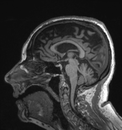 Behavioral variant frontotemporal dementia and late onset schizophrenia (Radiopaedia 52197-58083 Sagittal T1 46).png