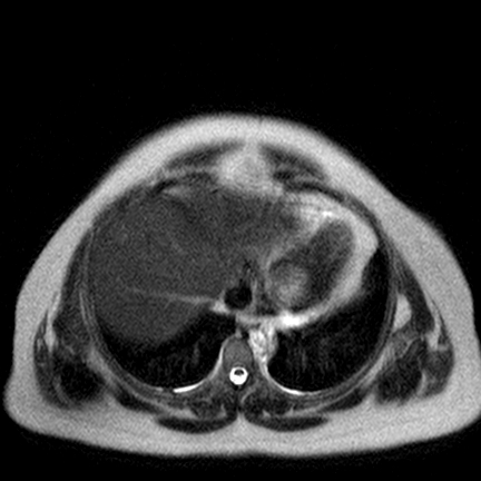 File:Benign seromucinous cystadenoma of the ovary (Radiopaedia 71065-81300 Axial T2 22).jpg