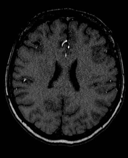 Berry aneurysm of the terminal internal carotid artery (Radiopaedia 88286-104918 Axial TOF 151).jpg