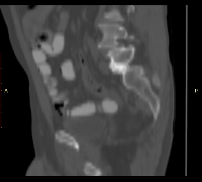 Bertolotti syndrome (Radiopaedia 58974-66235 Sagittal bone window 40).jpg