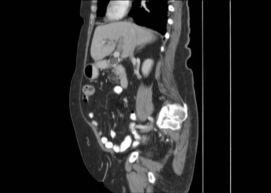 Bicameral celiacomesenteric aneurysm (Radiopaedia 55766-62327 B 23).jpg