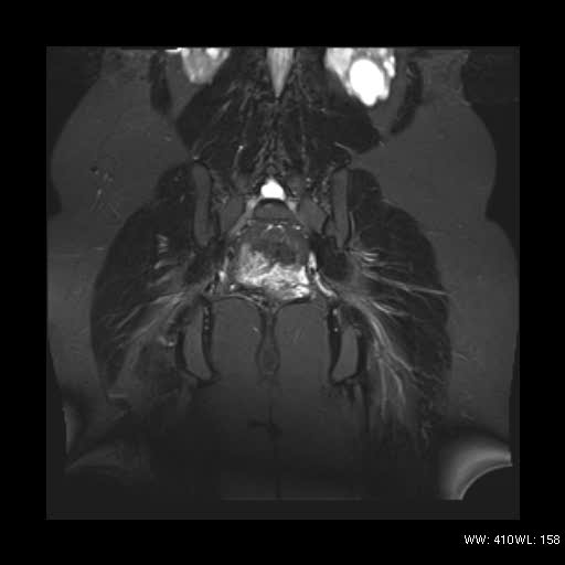 File:Bicornuate uterus- on MRI (Radiopaedia 49206-54297 Coronal STIR 15).jpg