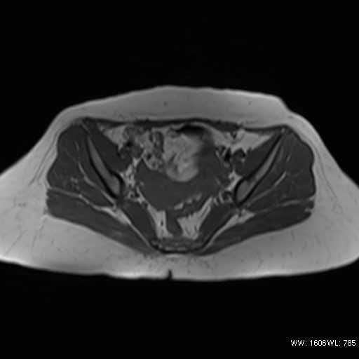 File:Bicornuate uterus (MRI) (Radiopaedia 49206-54297 Axial 13).jpg