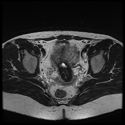 File:Bicornuate uterus (Radiopaedia 51676-57472 Axial T2 17).jpg
