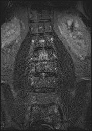 File:Bilateral L2 spondylolysis (Radiopaedia 56596-63350 Coronal STIR 12).jpg